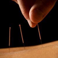 Woman getting an acupuncture treatment